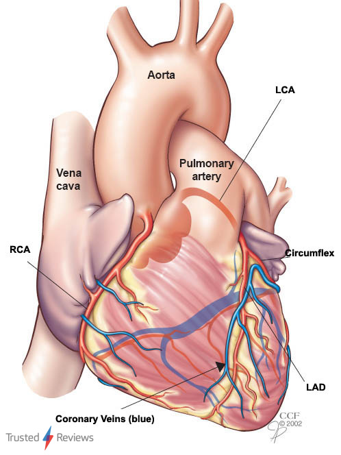 CAD (Coronary Artery Disease)
