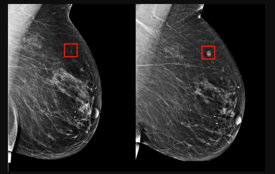 Tumor Availability Leading to Breast Cancer