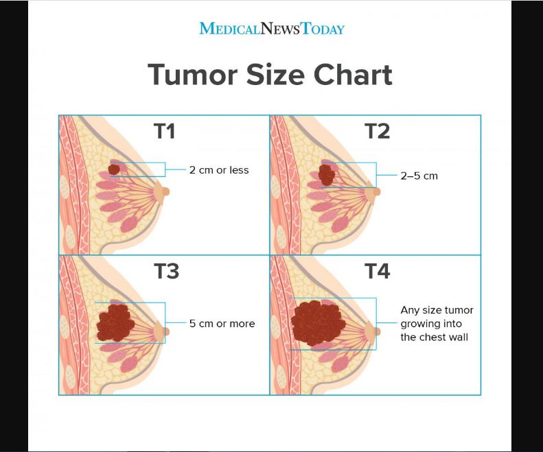 Tumor Size chart